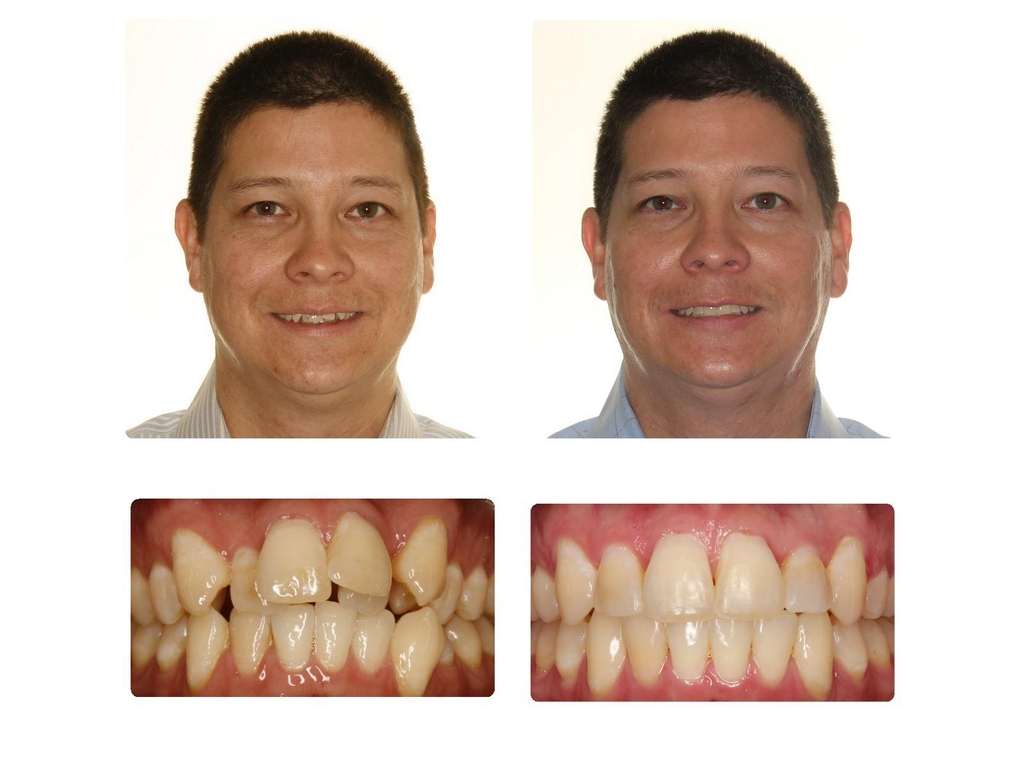 Before & After Orthodontic Treatment - Invisalign Austin